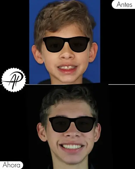 Transformación dental con brackets estéticos en Del Valle